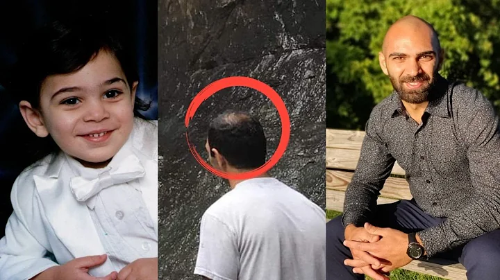 I Balded In My Early 20's - How I Accepted My Hair Loss And Shaved My Head