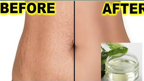 In 3 days Remove Stretch Marks Completely/World