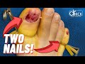 INGROWN TOENAIL REMOVAL DUE TO PAINFUL FUNGAL TOENAILS! | Dr. Nick Campitelli