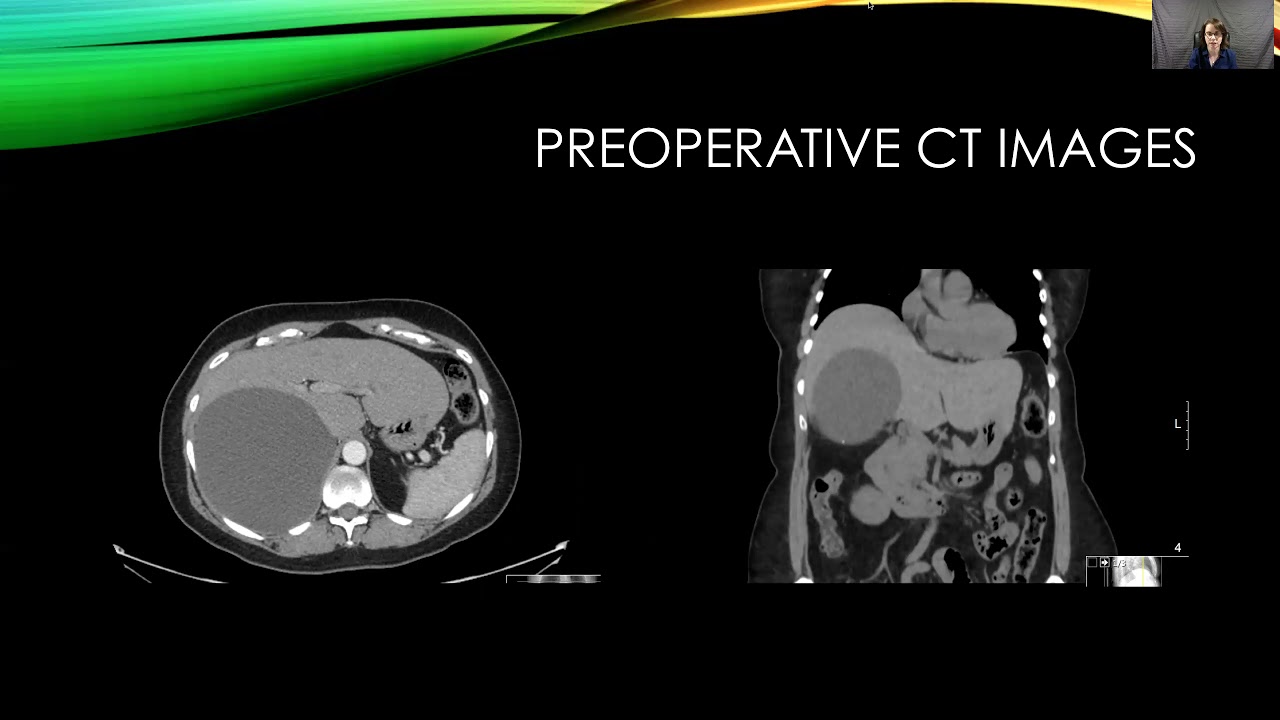 LAPAROSCOPIC MANAGEMENT OF A SYMPTOMATIC LIVER CYST IMPOSTER
