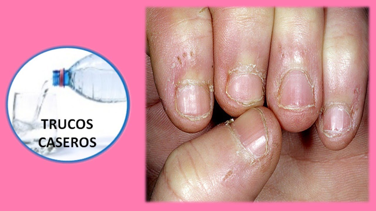 porque salen hongos en las u as como prevenir y evitar los padrastros de los dedos porque salen hongos en las u as como prevenir y evitar los padrastros de los dedos