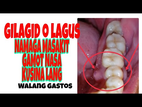 Video: Paano Magagamot ang Sakit sa Gum Sa Mga Gamot na Ginawa (na Mga Larawan)