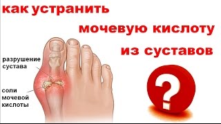 ВЫВЕДЕНИЕ МОЧЕВОЙ КИСЛОТЫ ИЗ СУСТАВОВ, РЕЦЕПТЫ ВЫВЕДЕНИЕ МОЧЕВОЙ КИСЛОТЫ ИЗ СУСТАВОВ, РЕЦЕПТЫ