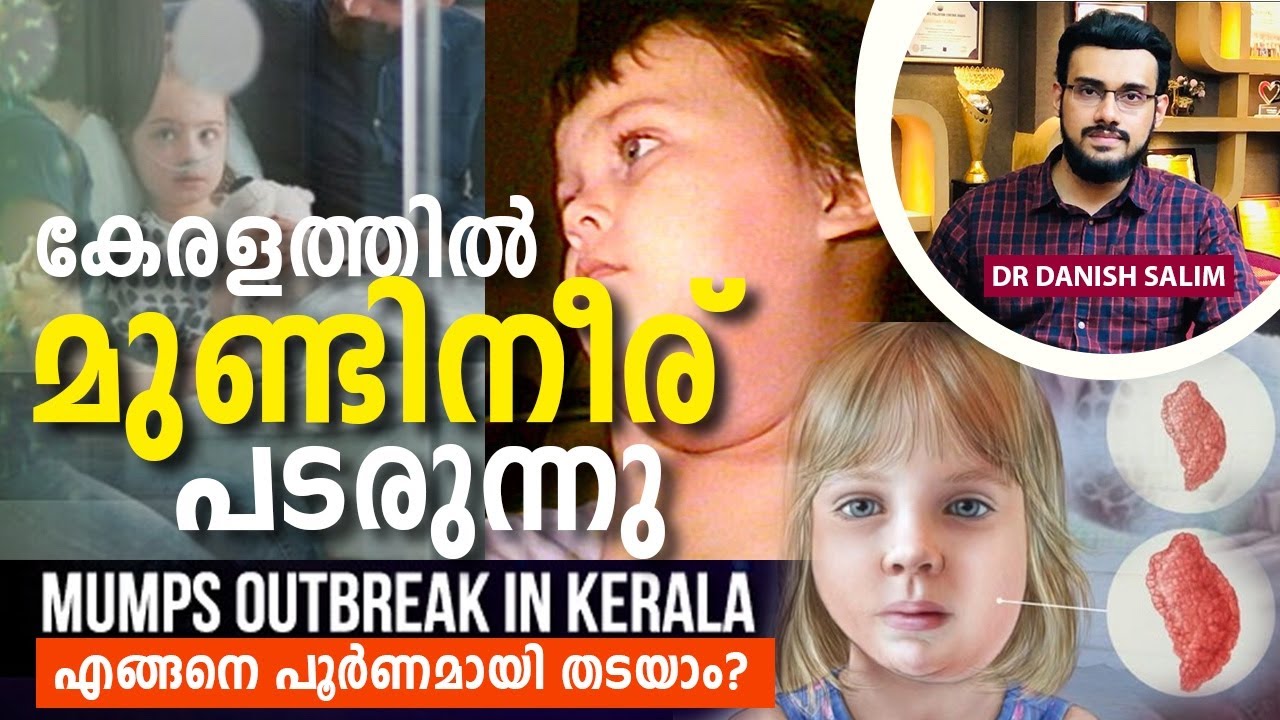 2151: കേരളത്തിൽ Mumps മുണ്ടിനീര് പടരുന്നു എങ്ങനെ പൂർണമായി തടയാം? | Mumps in Kerala