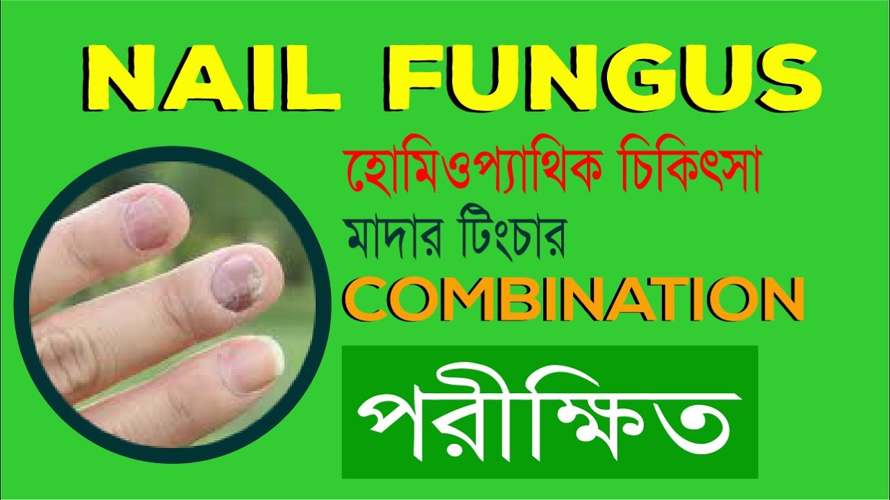 Nail Fungus treatment in Homeopathy medicine YouTube