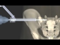 iFuse Implant System - Minimally Invasive Sacroiliac Joint Surgery