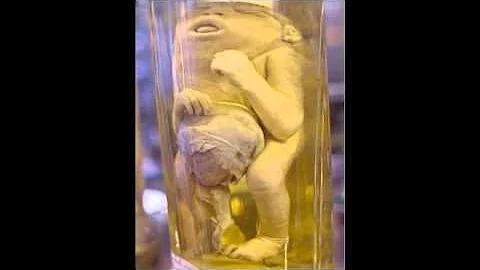 تحميل 閲覧注意 恐怖の難病 奇形人間 奇形児画像 ココロ刺激 تحميل 閲覧注意 恐怖の難病 奇形人間 奇形児画像 ココロ刺激