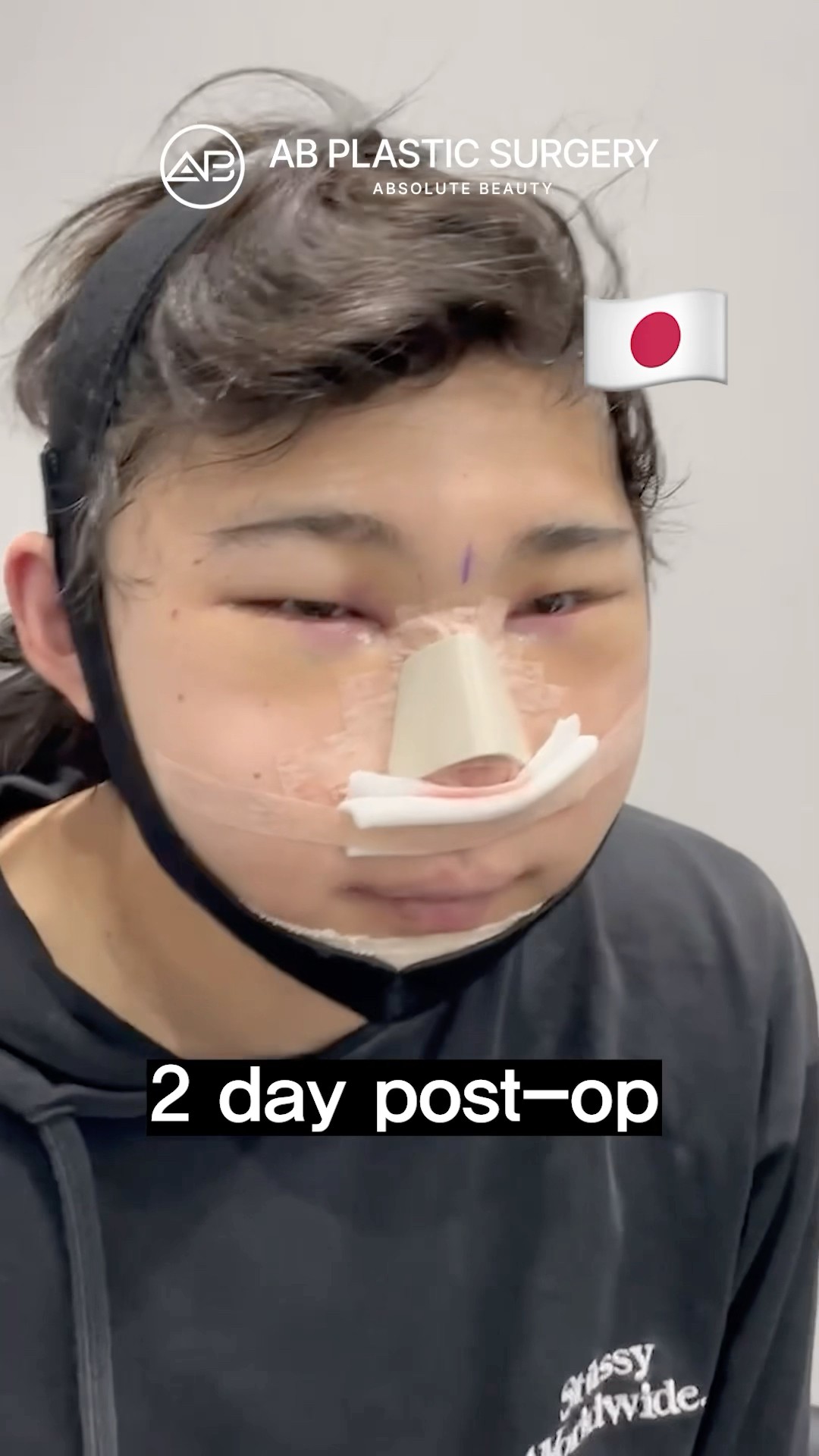 Jaw & Nose Surgery in Korea Changed His Whole Face #koreanplasticsurgery