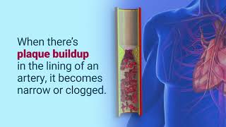 Coronary Artery Bypass Surgery