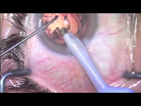 Crystalens AO cataract surgery by Steven G. Safran MD