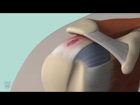 Video: 3 Cara Tidur dengan Rotator Cuff Pain
