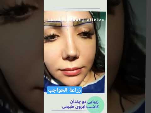زراعة الحاجب بعد إزالة الوشم