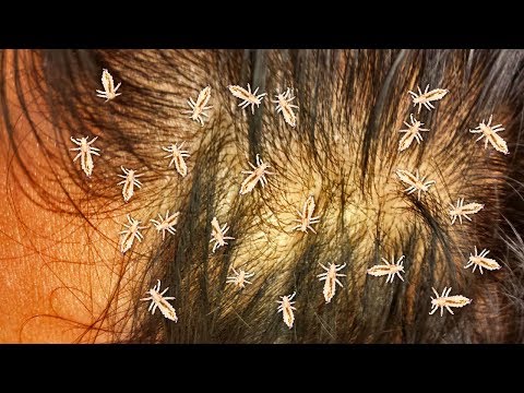 BIGGEST Lice Infestations of All Time - Head Lice Facts