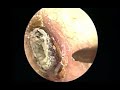 Dr Xing  - Difficult cases of ear treatment