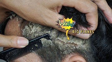 Itchy Dry Scalp Scratching Dandruff Satisfying #1261