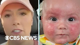 Mom shows baby's allergy when she gets different formula amid shortage