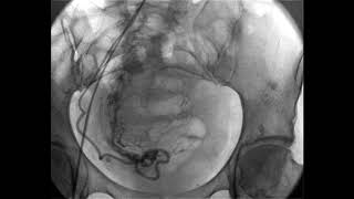 Abdominal fluoroscopy - Flat detector 30*30 cm