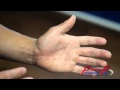 Numbness in Fingers & Hand - Huntington Beach Chiropractor - Chiropractic Clinic Orange County