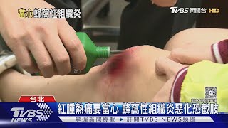 蜂窩性組織炎別輕忽! 醫師示警:出現「這五種」狀況 提高警覺!|十點不一樣20250915