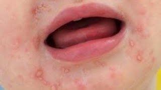 متلازمة اليد والقدم والفم | الأسباب والأعراض والمضاعفات  Hand, foot and mouth disease