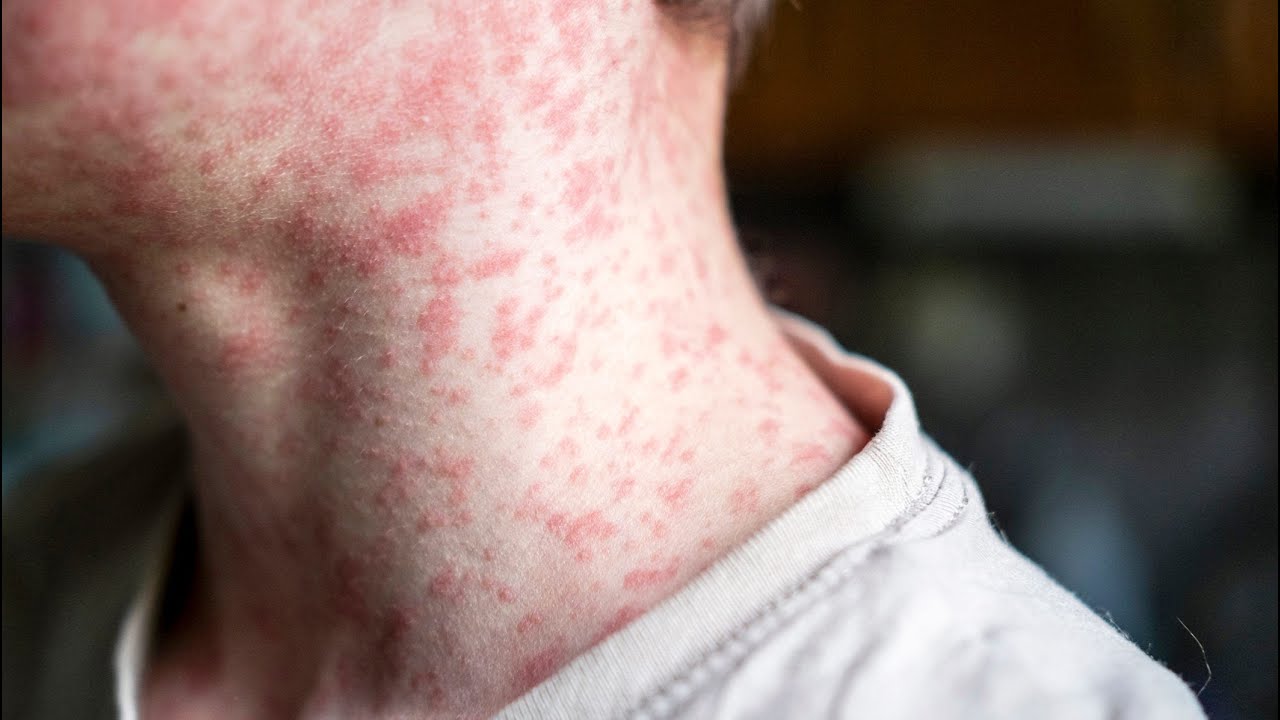 SC measles outbreak : What it could mean for Mass.