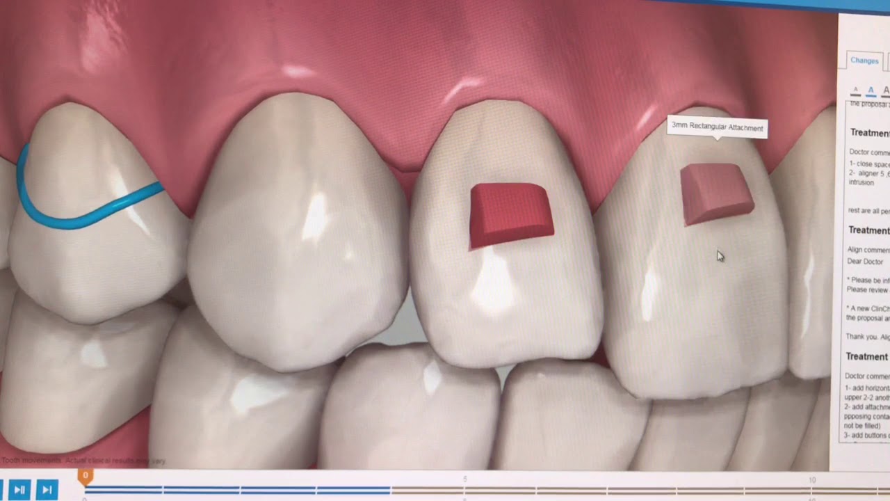 Invisalign open bite treatment by Ammar DDS from elite orthodontics