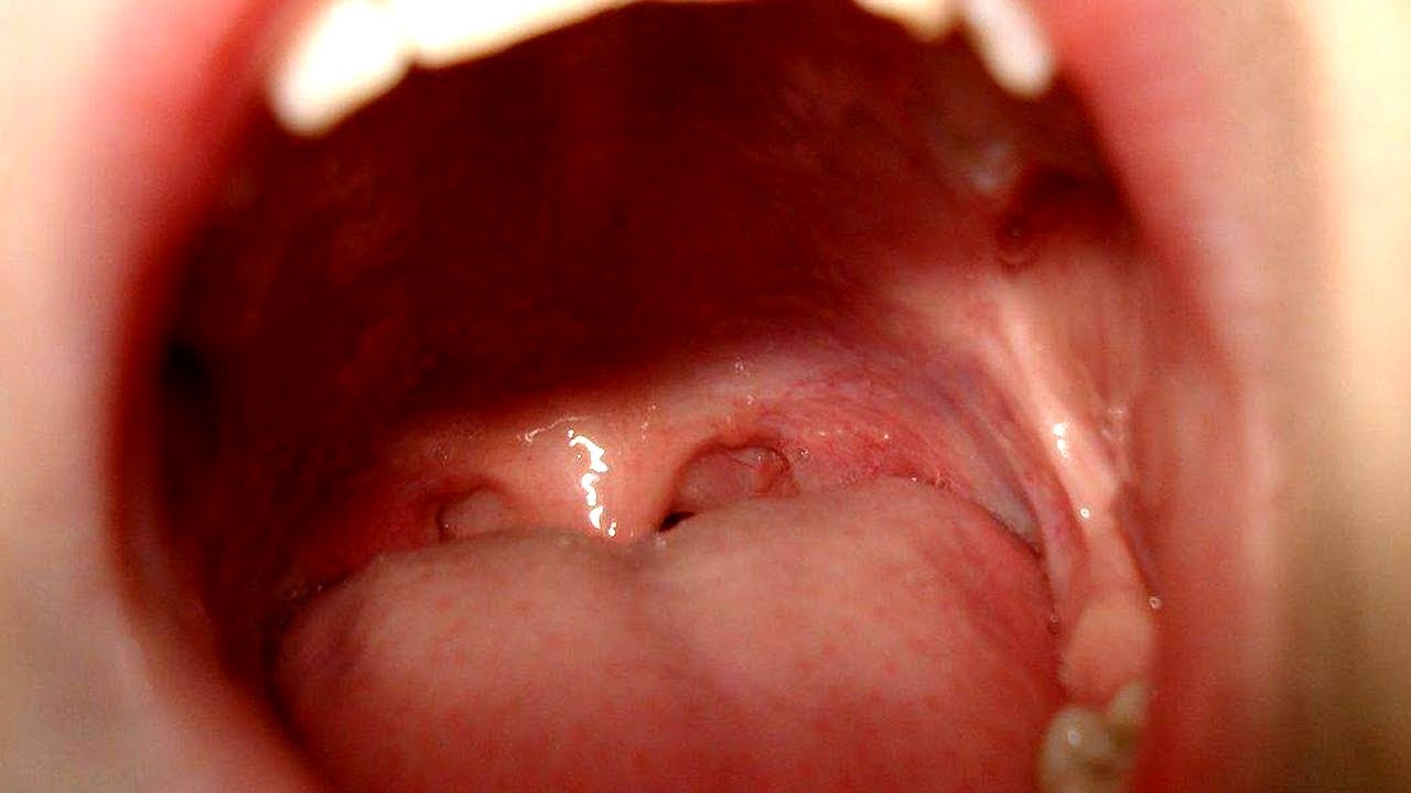 Ангина гнойная у детей - YouTube