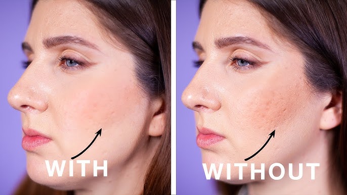 How to Hide Acne Scars with Makeup - L'Oréal Paris