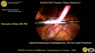 LaparoThoracoscopic esophagectomy: The Ivor Lewis procedure