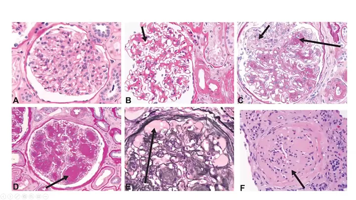 Basics of Renal Pathology : Diabetic Nephropathy