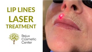 Lip Lines Sciton LaserTreatment- Rejuv Cosmetic Center NJ How A Plastic Surgeon Treats Lip Lines