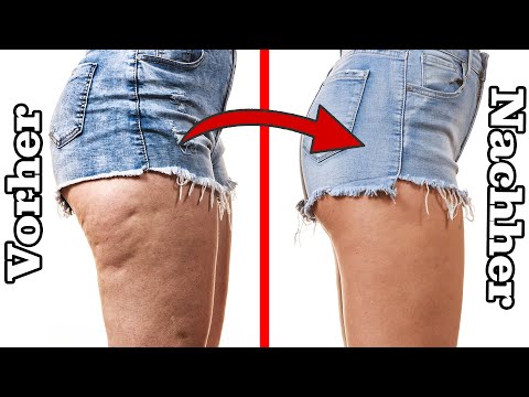 Video: Cellulite Und Dehnungsstreifen: 8 Sterne, Deren Figuren Alles Andere Als Ideal Sind