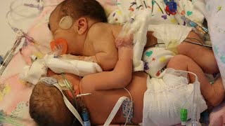Family celebrates miracle after conjoined twins survive separation