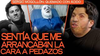 I WAS BRUTALLY ATTACKED WITH ACID AND AFTER MORE THAN 60 SURGERIES, I MANAGED TO SURVIVE: I WAS B...