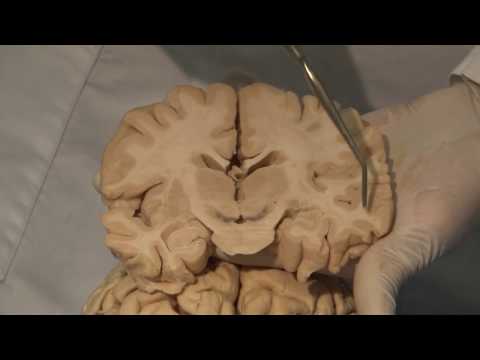 Video: Verschil Tussen Cerebrum En Cerebrale Cortex