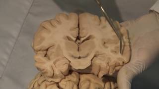 Cortical Localization: Neuroanatomy Video Lab - Brain Dissections