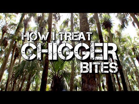 Wie man Chiggers behandeln