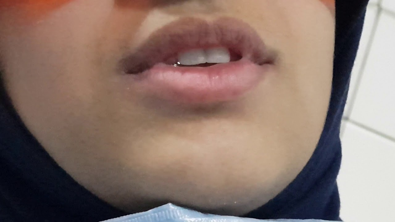 علاج مشاكل ومنها سن مدفون  وسن ناقص.Ortho Treat of Impacted Tooth.d