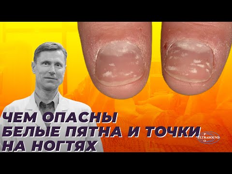 Чем опасны белые пятна и точки на ногтях.