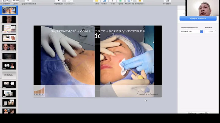 Dr. Luis Badani - Sustentacin facial con hilos ten...