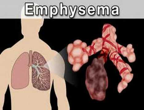 Understanding Chronic Obstructive Pulmonary Disease (COPD#1)