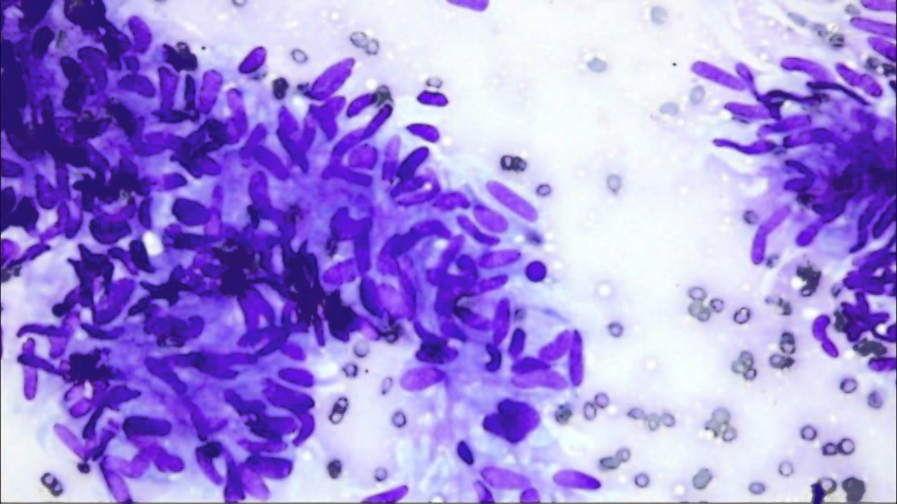 EUS Cytopathology Quiz 1 - YouTube