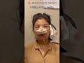 I cried when watching this fyp glowup facialcontouringsurgery rhinoplasty plasticsurgery