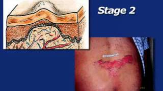 褥創の処置【詳細はこちらで公開：http://www.nursingskills.jp/】