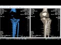 Перелом мыщелка большеберцовой кости (часть 4 из 5)