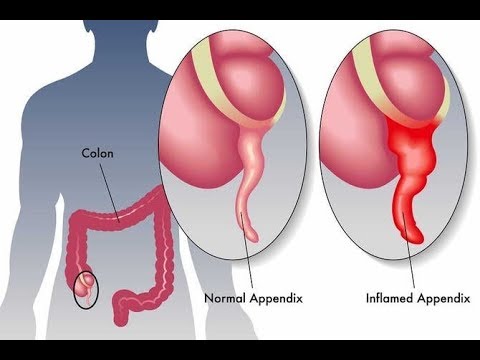 اعراض الزائده المبكره