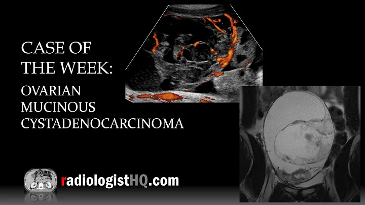 Case of the Week: Ovarian Mucinous Cystadenocarcinoma (Ultrasound & MRI) - DayDayNews