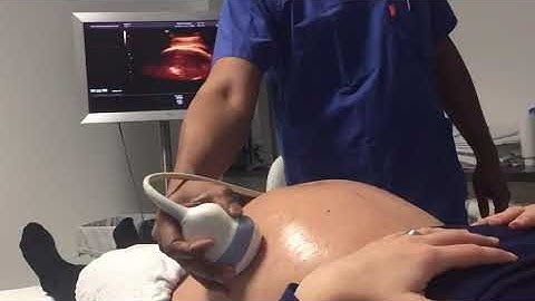 Understanding how to do soft touch ECV for breech. Would you like this experience?#ecv #pregnancy 