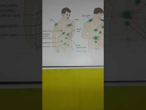 MSN GASTRIC PAIN Or COMMON SITE S REFERRED ABDOMINAL PAIN EXPLANATION FOR GI DISEASES