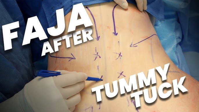 Post-Tummy Tuck Secrets: Compression after Surgery 
